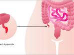 Ilustrasi Penyakit Usus Buntu