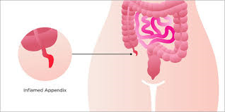 Ilustrasi Penyakit Usus Buntu